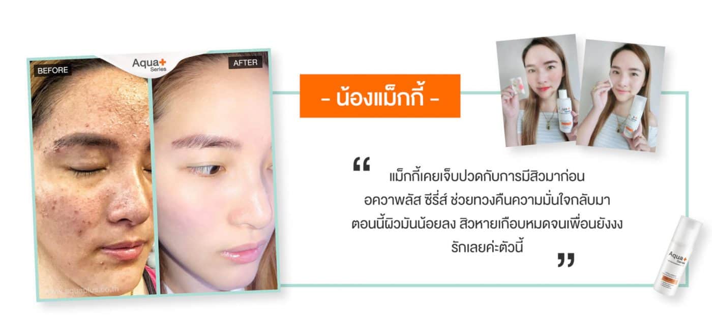 แนะนำโฟมล้างหน้าสำหรับรักษาสิวโดยเฉพาะ