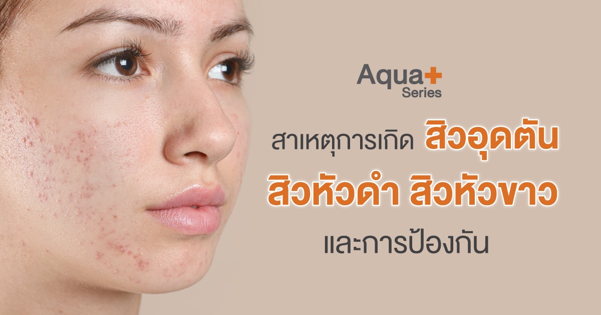 6 เรื่อง สิวอุดตัน ต้องรู้ก่อนสายไป – Aquaplus Thailand
