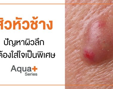 สิวหัวช้าง